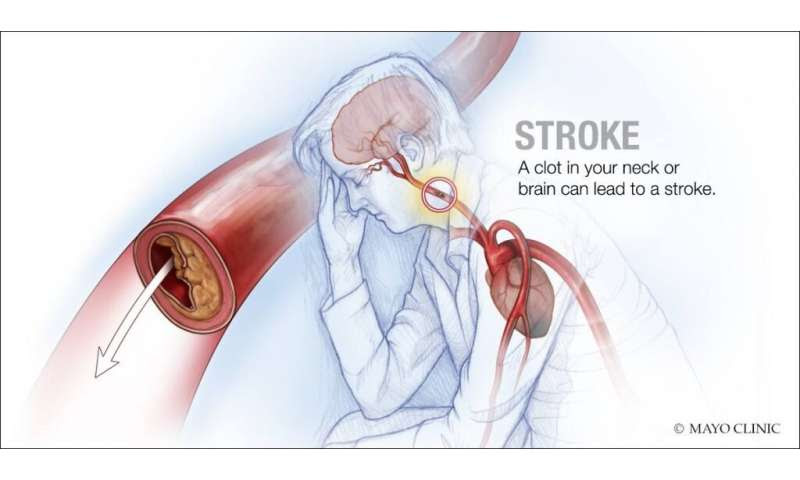 Protein in blood may predict prognosis, recovery from stroke