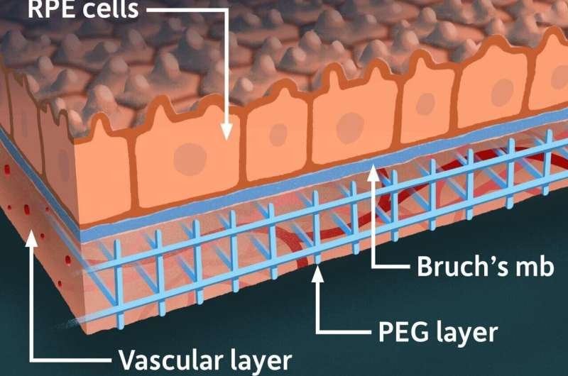 Lab model offers hope for macular degeneration patients