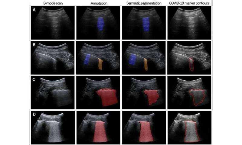 Intelligent lung ultrasound provides crucial support for COVID-19 testing within minutes