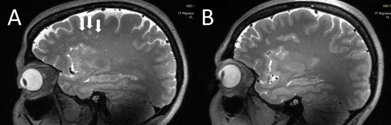 Ultra-high-res MRI reveals migraine brain changes