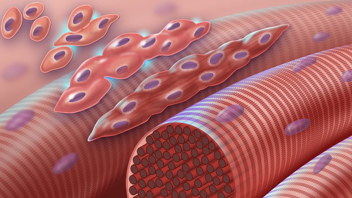 The graphic depicts normal myoblasts (early muscle cells with a single nucleus) fusing together to form muscle cells with more than one nucleus. The cascade is disrupted in Carey-Fineman-Ziter syndrome, because of a defect in the membrane protein, myomaker, which is required for cell-cell fusion.