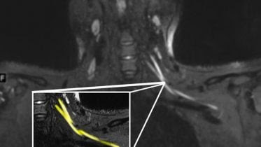 MRI Shows COVID-19 Nerve Damage in Neck