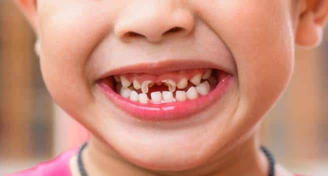 Image result for Excess use of toothpaste by kids leads to tooth decay