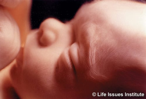 20-weeks-human-fetus3-e1548532527251
