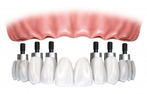 Tooth Implants: Don't Even Think About Having Them!