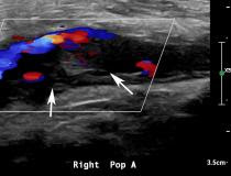 Ultrassonografia mostrando trombose de artéria poplítea e tibial posterior em uma mulher de 58 anos com COVID-19 na UTI.  Imagens sagitais de ultrassom com Doppler espectral mostram um trombo heterogêneo ecogênico (setas brancas) distendendo a artéria poplítea direita.  O knocking característico ou forma de onda “stump-thump” com ausência de fluxo diastólico e baixa amplitude implica a presença de oclusão logo distal à área de interrogação.
