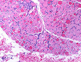 necrotic muscle fiber with Duchenne's Muscular Dystrophy