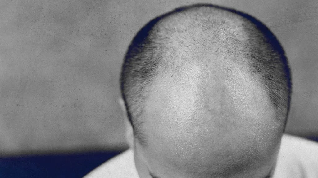 scalp with male patterned baldness