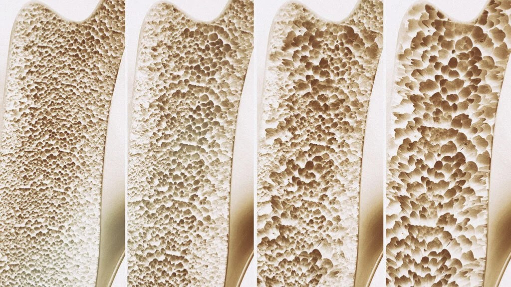 Stages of osteoporosis to accompany an article about vitamin D deficiencies in men and aging.