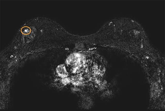 MRI may lower breast cancer deaths from variants in 3 genes