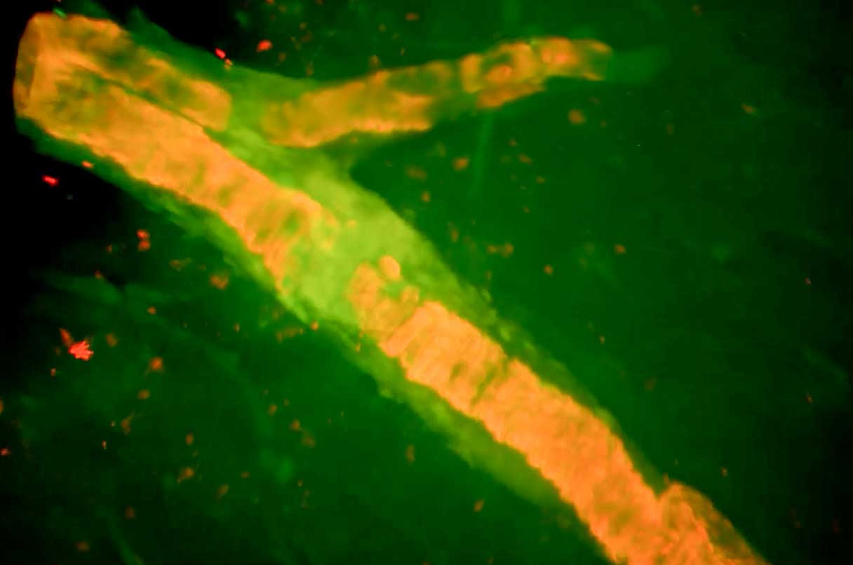 brain scan shows amyloid (orange) lining blood vessels and spot where a vessel ruptured and bled