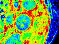 imagen de microscopía acústica de células de linfoma folicular.