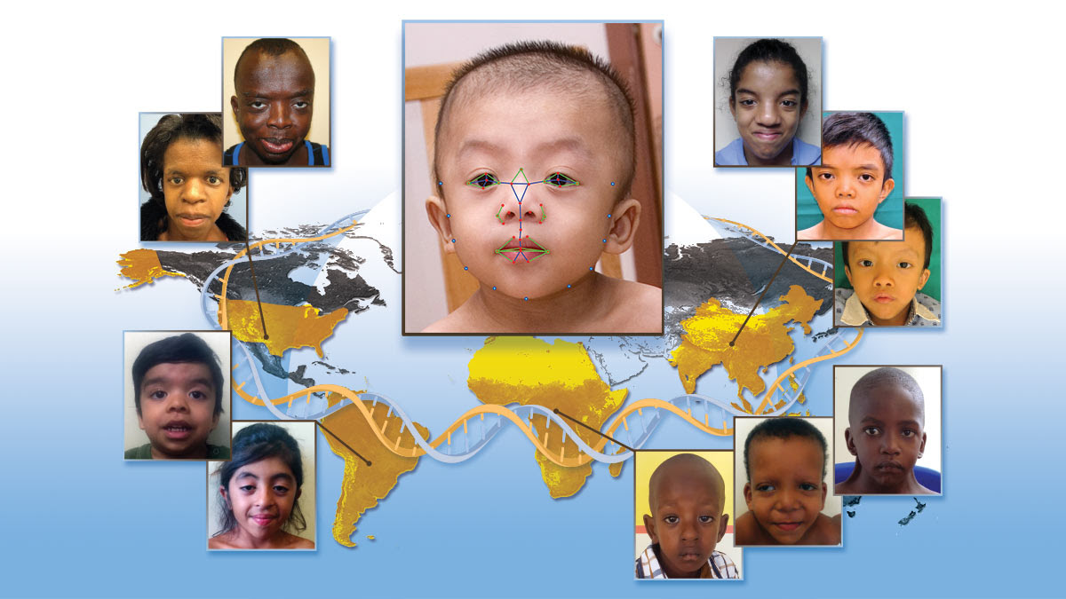 diverse people with Noonan Syndrome