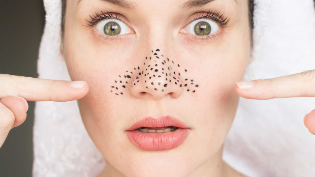 Saiba tudo o que precisa de fazer para remover e prevenir a acne