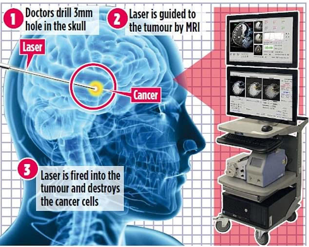 The procedure involves a fine narrow tube being inserted into the tumour before a laser is beamed down it, gradually heating up to about 70C, breaking down and killing the cancerous cells