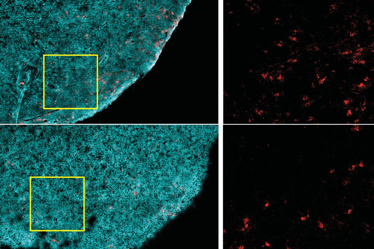 Levels of CD8+ T cells (red) in tumors (cyan) appear to be higher in mice on lower-fat diets (top row) than those on high-fat diets (bottom row)