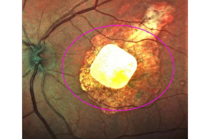 Implanted chip, natural eyesight coordinate vision in study of macular degeneration patients