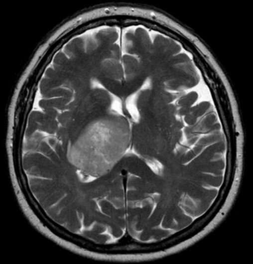 Glioblastoma in older adults: Improving survival and quality of life