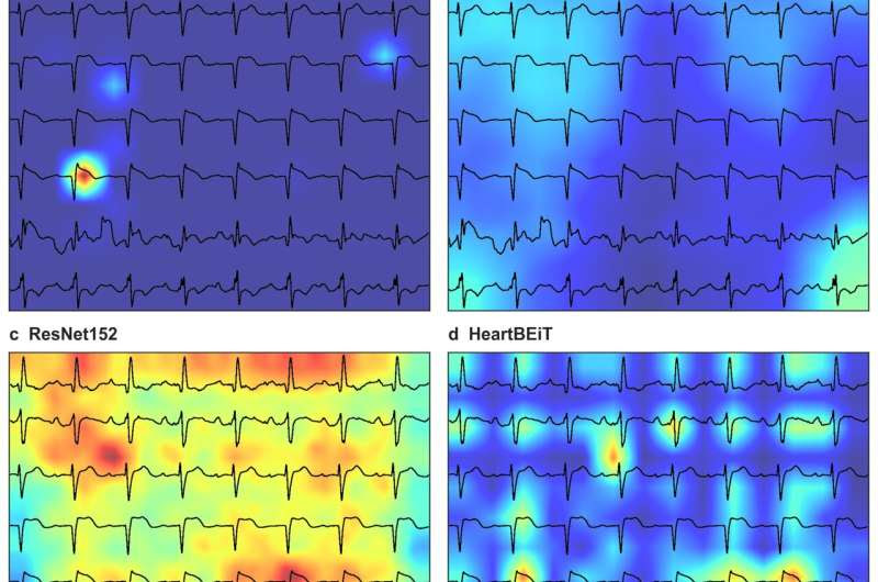 Mount Sinai researchers use new deep learning approach to enable analysis of electrocardiograms as language