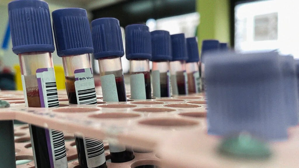 A tray of blood samples for anti-CCP testing.