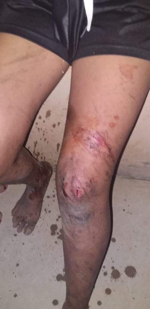 Pessoa foi ferida pelos seguranças da SeguPro à serviço da Vale em conflito por terra