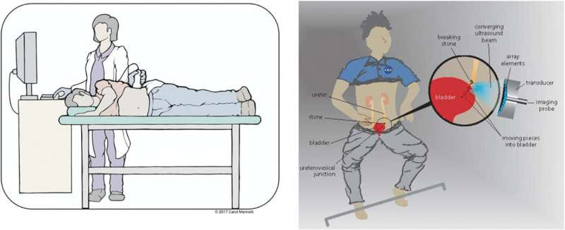 Awake patients can have kidney stones moved, blasted