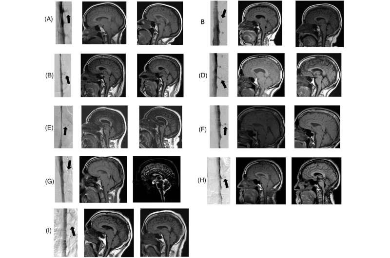 New research detects potential hidden cause of dementia