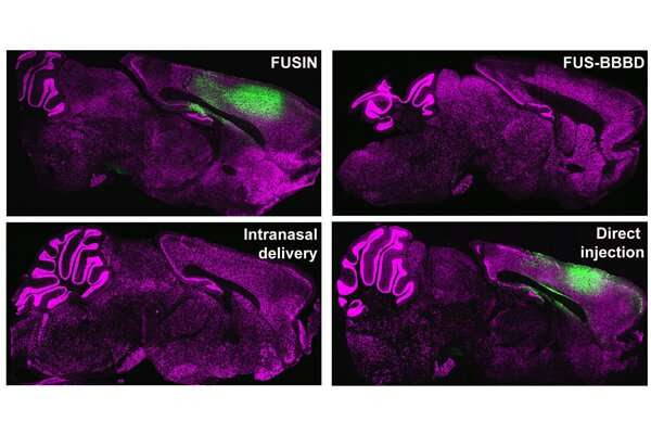 A sound approach for effective gene therapy delivery to brain