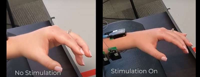 Spinal cord stimulation shown to instantly improve arm mobility after stroke