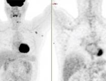 Um paciente de 63 anos de idade com mieloma múltiplo com dor esquelética apresentando nova linfadenopatia axilar ávida por FDG PET-CT 62 dias (9 semanas) após a segunda dose de vacinação de mRNA de COVID-19.  A captação no linfonodo é típica de pacientes vacinados, com a adenopatia ocorrendo no lado do braço que foi vacinado.  Exemplo de adenopatia axilar da vacina COVID-19.  Imagem cortesia da RSNA.