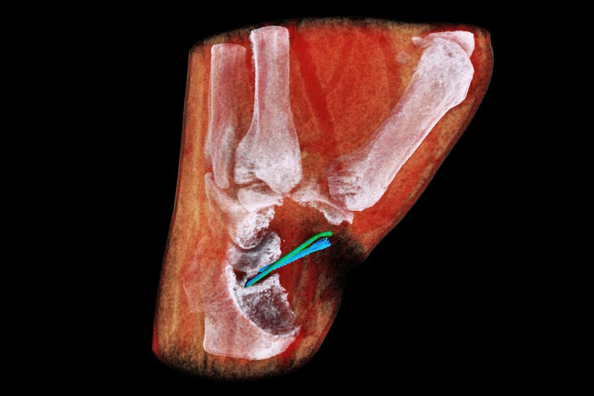 MBI's 3D scanner assigns colors based on different densities of tissue – so bones appear white, muscle appears red and implants appear blue and green