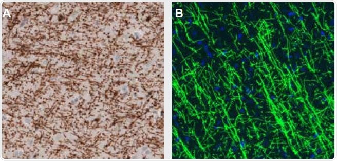 Representative staining of Myelin Basic Protein using Anti-MBP monoclonal antibody (AMAb91063). (A) Immunohistochemical staining of the human cerebral cortex shows strong immunoreactivity in myelinated fibers. (B) Immunofluorescence staining in the rat cerebral cortex shows strong immunoreactivity in myelinated axons. See Table 4. for a list of Oligodendroglial markers available from Atlas Antibodies.