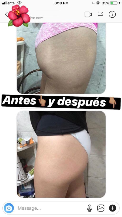 Estrías Antes y Después 2