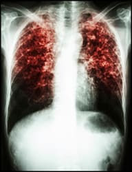 In 2014, a total of 9,412 new tuberculosis cases were reported in the United States, with an incidence of 3.0 cases per 100,000 population.
