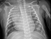 Radiografia de tórax de um paciente pediátrico com insuficiência cardíaca da COVID.  Radiografia de tórax de um bebê de 2 meses com diagnóstico de COVID-19 mostrando um coração aumentado, opacidades bibasilares causadas por colapso das seções inferiores dos pulmões e atelectasia do lobo superior direito (colapso do pulmão).