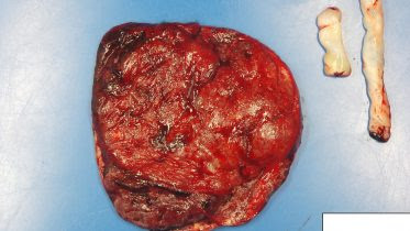 Maternal-Side COVID Impacted Placenta