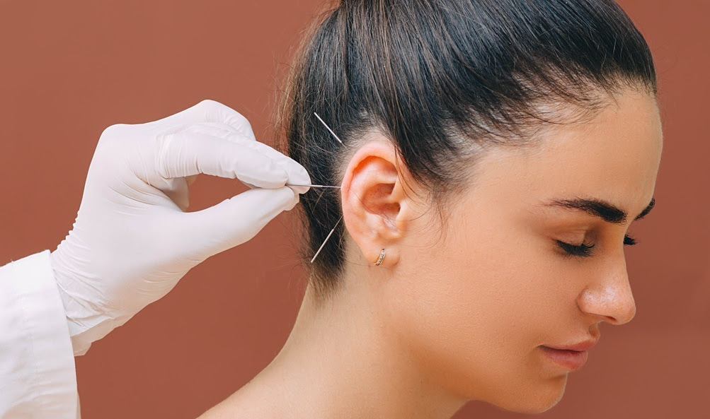 woman receiving acupuncture treatment