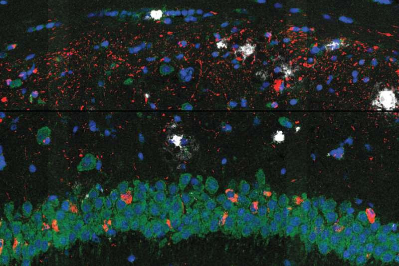 Researchers map brain cell changes in Alzheimer's disease