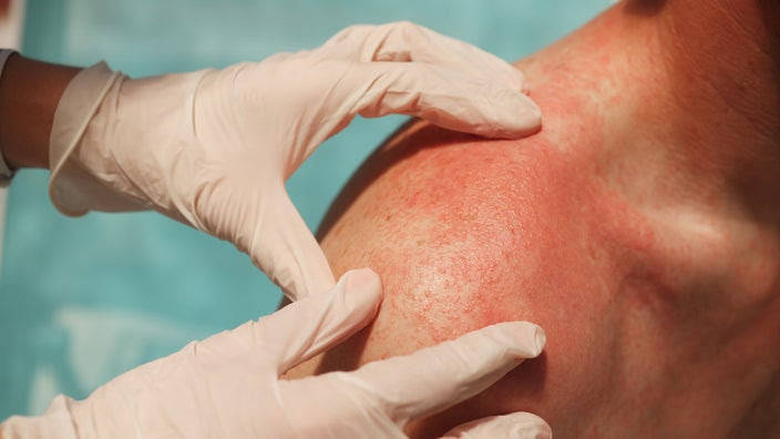 A dermatologist examines a skin rash on a man's shoulder.