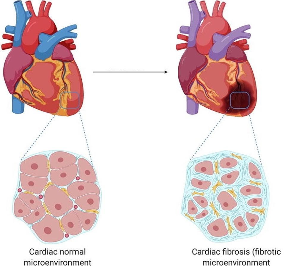 Comparison of healthy heart to fibrotic heart