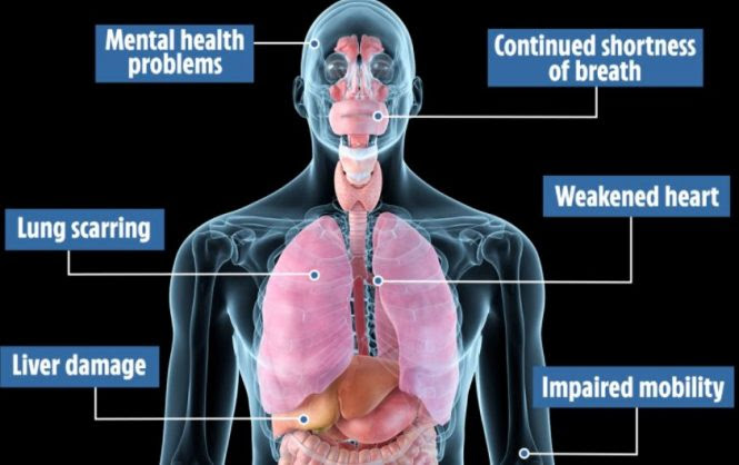 Some people with COVID-19 have “long COVID” or lingering symptoms for weeks or months after they begin to recover. More than 40% of people who have or had COVID-19 get long COVID. Among people who needed hospitalization, the stats go up to 57%. About 10% of people between ages 18 to 49 who have COVID-19 get long COVID. The odds go up to 22% for those 70 or older. It can happen to anyone, whether you’re otherwise healthy or have other health conditions. You can get it even if your earlier COVID-19 symptoms were mild or moderate.