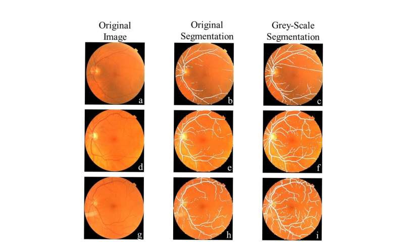 Eye exam could lead to early Parkinson's disease diagnosis