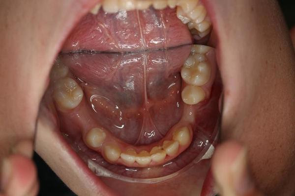 Vrzeli v spodnji čeljusti, od koder so vzeli zoba za presaditev, bodo zaprli z ortodontskim zdravljenjem.