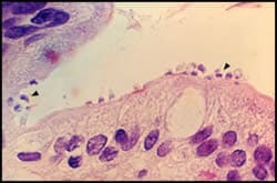 Cryptosporidium parasites in a patient’s small bowel epithelial cell lining.
