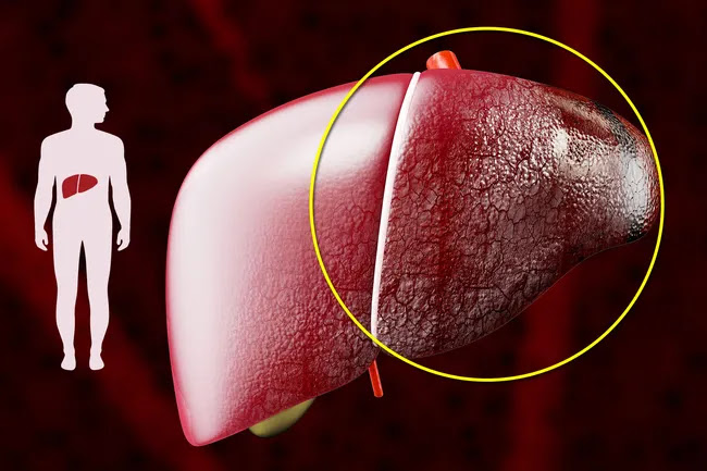 cirrhosis tissue damage