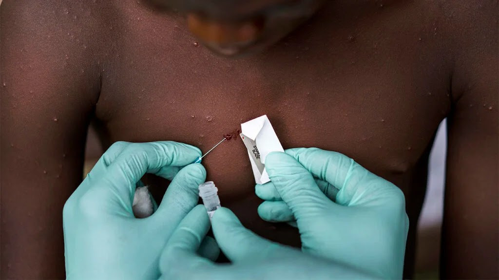 A healthcare workers takes a sample from a scab suspected to be monkeypox infection in a child