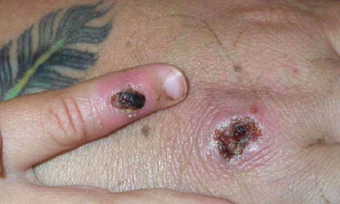 Another ‘Presumptive’ Case of Monkeypox Reported in US: Officials