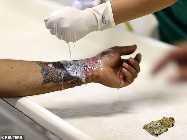 A nurse is pictured cleaning a patient's hand after removing tilapia fish skin at Dr Jose Frota Institute on May 2 last year. A big advantage of the alternative therapy is the lack of daily dressing changes. Patients have also reported less pain and faster wound healing