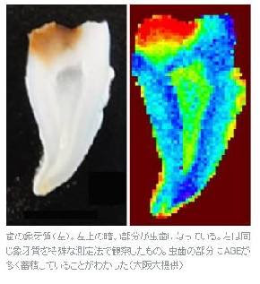 虫歯