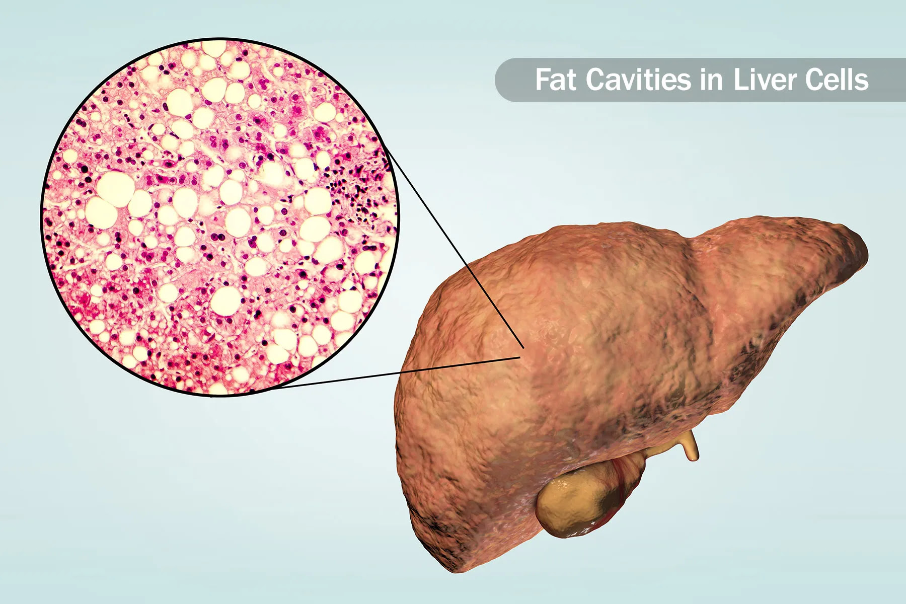 fatty liver